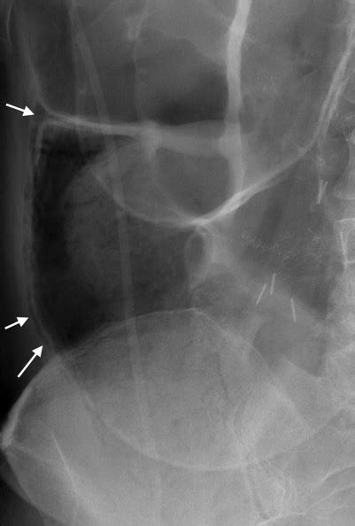 Interpreting An Abdominal X Ray Kub Stepwards