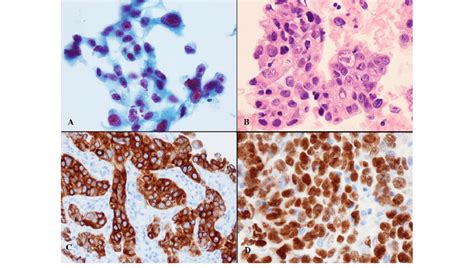 Immunostaining Of Non Small Cell Lung Carcinoma Favoring Squamous Cell