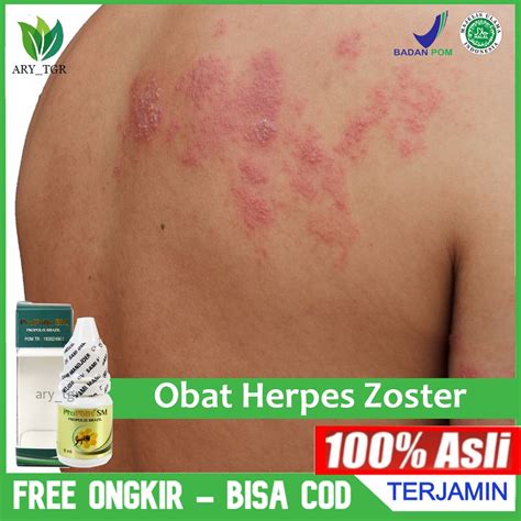 Jual Obat Herpes Zoster Herpes Simplex Herpes Kelamin Penyakit Herpes