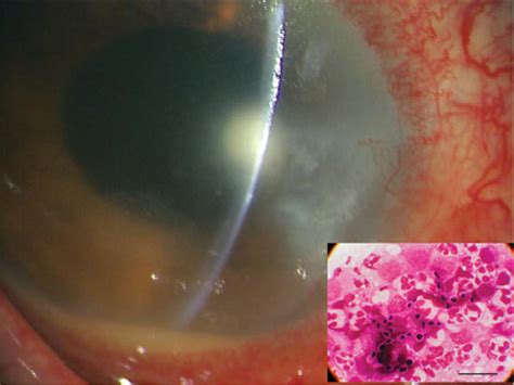 Figure 2 From Candida Albicans Keratitis Modified By Steroid Application Semantic Scholar