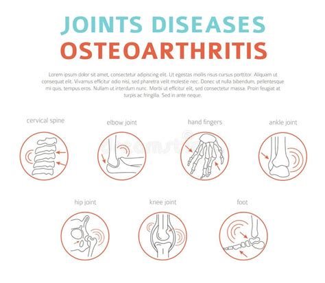 Joints Diseases. Arthritis, Osteoarthritis Symptoms, Treatment I Stock Vector - Illustration of ...