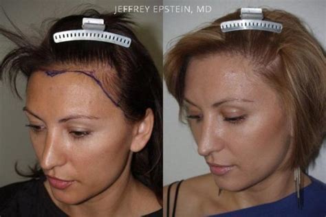 Forehead Reduction Surgery Photos Miami FL Patient37094