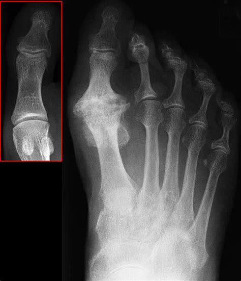 Osteoarthritis xray Home Remedies Log