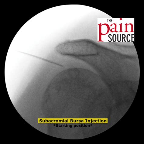 Subacromial Bursa Injection – Technique and Tips - The Pain Source - Makes Learning About Pain ...