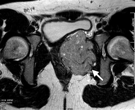 Uncommon Primary Pelvic Retroperitoneal Masses In Adults A Pattern Based Imaging Approach