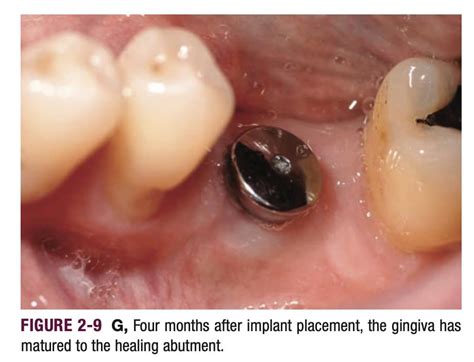 Dental Implant Healing Pictures Best Guide