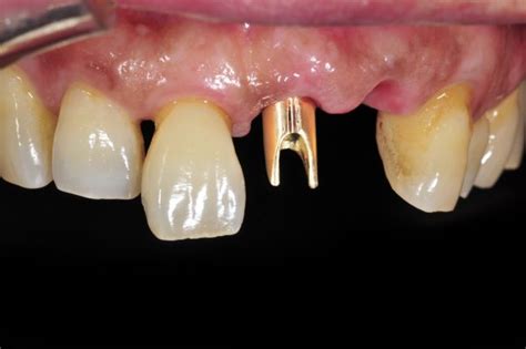 Porcelain Fused To Metal Pfm Bridge 9 To 10 Creodent