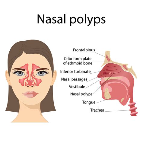 Médico Vector Ilustración De Nasal Pólipos No Canceroso Neoplasias En