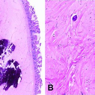 A Gross Appearance Of The Tumor In The Segment Of The Small Bowel