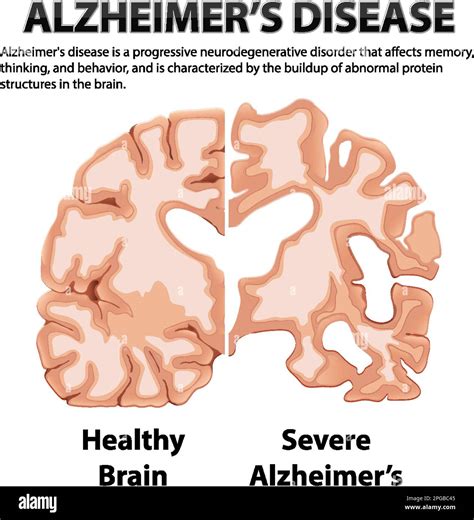 Informative Poster Of Alzheimers Disease Illustration Stock Vector