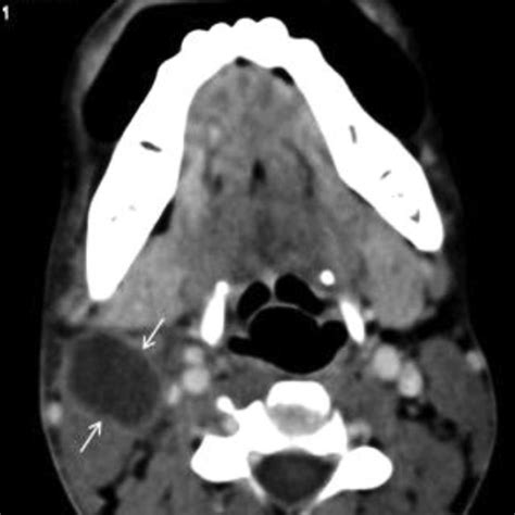 Pdf Cystic Masses Of Neck A Pictorial Review