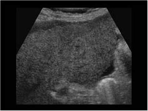 Abdomen and retroperitoneum | 1.1 Liver : Case 1.1.12 Cirrhosis and ...