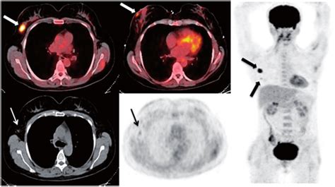 Multifocal Invasive Ductal Carcinoma In The Right Breast Upper Row