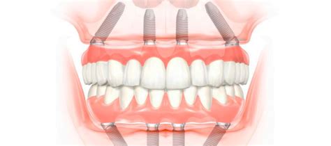 Reponer Toda La Boca Con Implantes All On Dentisalut