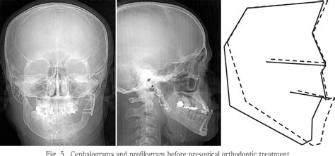 Figure 1 From A Case Of Mandibular Setback Operation After Mandibular Bone Reconstruction With