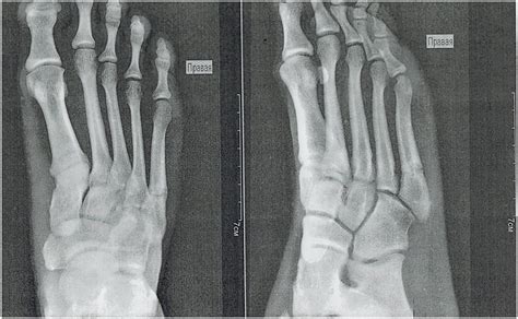 Metatarsal Fracture Orthopaedic Trauma Association Ota Off