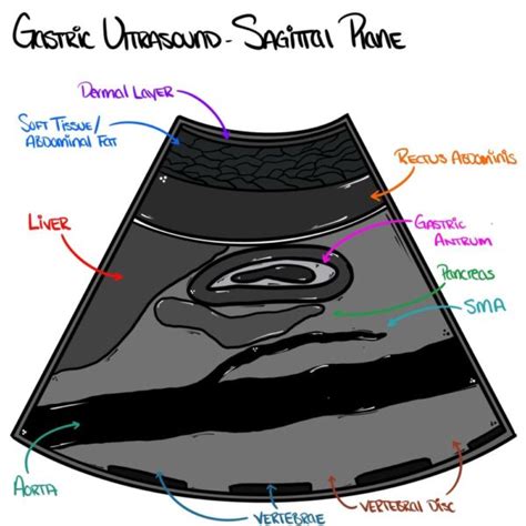 Gastric Point Of Care Ultrasound OpenAnesthesia