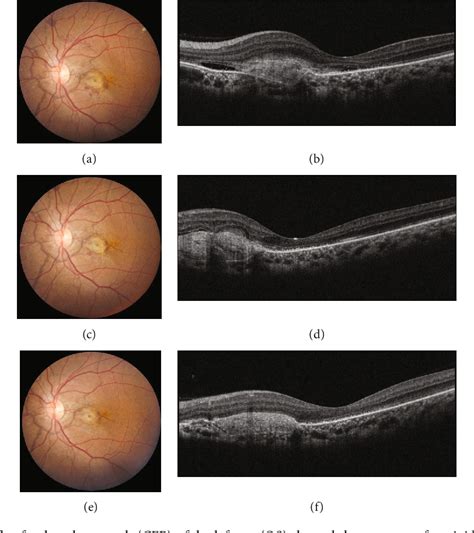 Figure From Intravitreal Brolucizumab For Choroidal