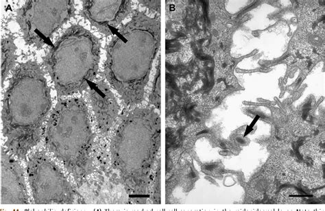 Figure From Transmission Electron Microscopy For The Diagnosis Of