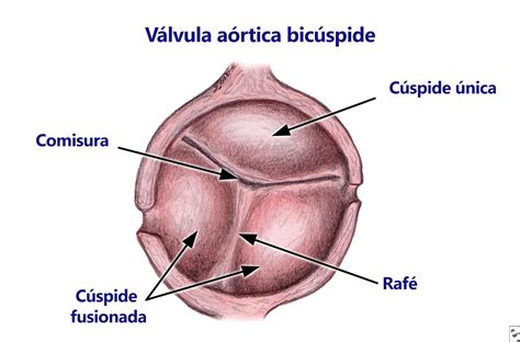 Mini Examen Cl Nico Actualice Sus Conocimientos Sobre V Lvula A Rtica