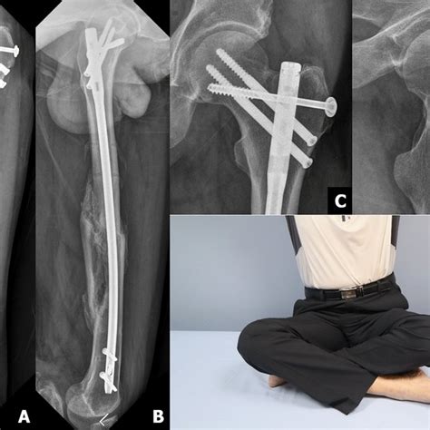 A Femoral Neck Fracture Was Reduced By Longitudinal Traction And