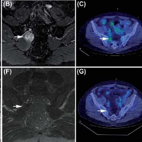 Case 2. (A, B) MRI brachial plexus. Sagittal T1 post-contrast and T2... | Download Scientific ...