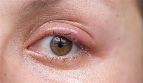 Blepharitis Blephex