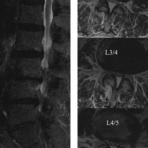 A Sagittal Plane And B Axial Plane Preoperative Spinal Mri Findings