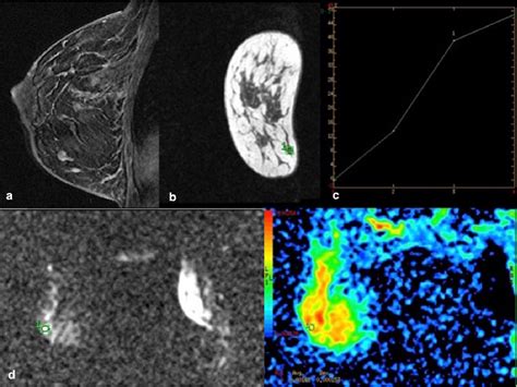 Figure 1 From Sclerosing Adenosis Vs Sclerosing Adenosis With