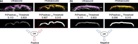 High‐speed Intra‐operative Assessment Of Breast Tumour Margins By Multimodal Ultrasound And