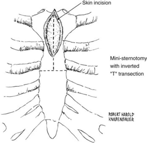 Anatomy And Surgical Exposure Of The Vascular System Thoracic Key