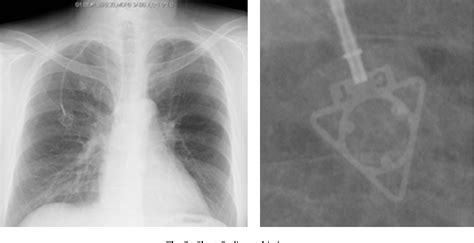 Figure 2 From Complications After Implantation Of Subcutaneous Central Venous Ports Powerport