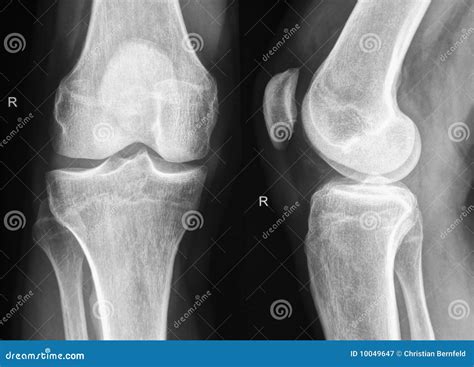 Radiografia De Rodilla