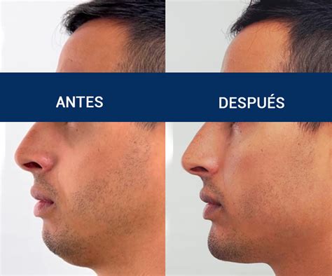 Masculinización Facial Tratamiento con Ácido Hialurónico Clínica