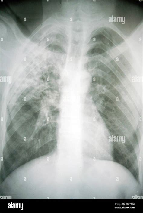 An A P Anterior Posterior Chest X Ray Of A Patient With Visceral