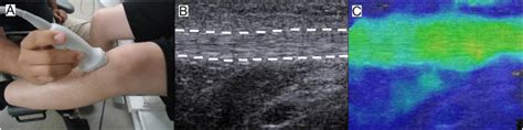 Shear Wave Elastography Of The Healing Human Patellar Tendon Following