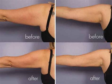 Arm Liposuction Without Surgery Liposuction Before And After Arm