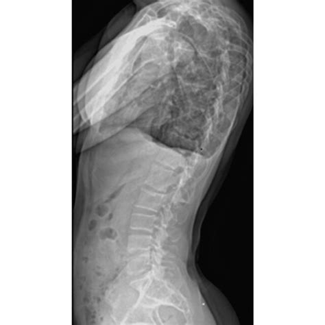 Anterior Posterior Ap View Of Erect Thoracolumbar Scoliosis Series