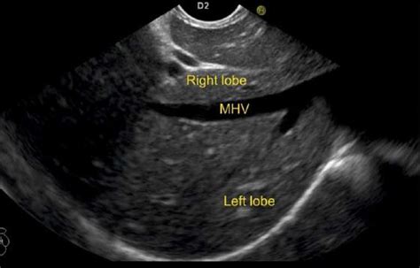 Linear Endoscopic Ultrasound Evaluation Of Hepatic Veins