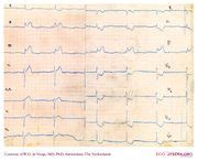 De Voogt ECG Archive Myocardial Infarction Atrial ECGpedia