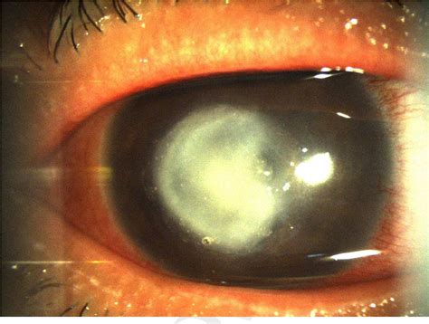 Figure 2 From Risk Factors And Clinical Features Of Acanthamoeba Keratitis In A Tunisian