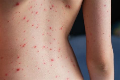 Varicella negli adulti cosa c è da sapere Nostrofiglio it