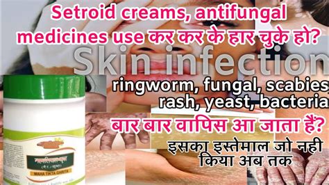 चर्म रोग बार बार लौट रहा हैfungal Ringworm Bacteria सब कुछ जड़ से खत्म और हमेशा के लिए आराम Dr