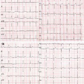 The Patient S Electrocardiography Ecg Showed Sinus Rhythm Biphasic T