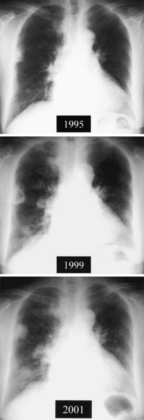 Figure 1 From Three Cases Of The Nodular Pulmonary Amyloidosis With A