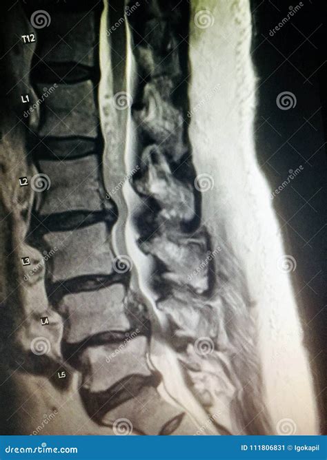 Severe Spinal Canal Stenosis Pathology Mri Exam Stock Image Image Of