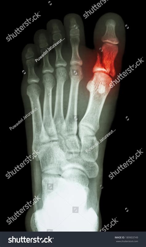 Film Xray Show Fracture Proximal Phalange Foto Stock