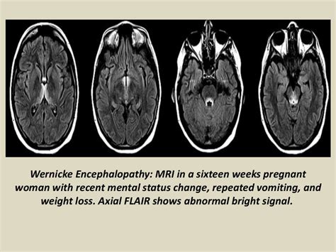 Presentation1 Radiological Imaging Of Wernicke Encephalopathy