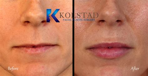 Lip Augmentation Before And After Gallery Dr Kolstad San Diego