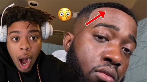 Jidion Gets His Hairline Back With Insane Hairline Surgery Must Watch Youtube